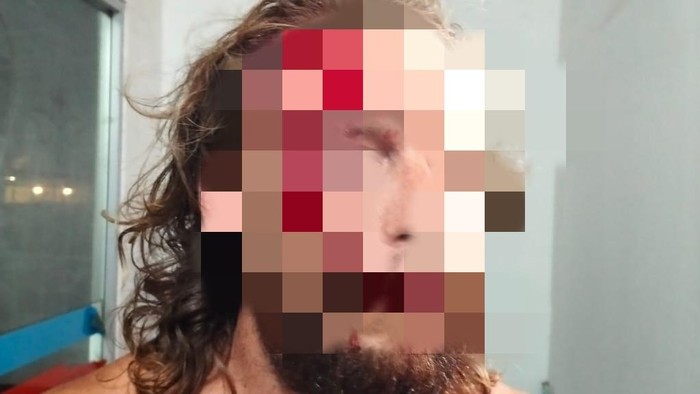 1761068001321-ed-33-wn-as-yang-menjadi-korban-penganiayaan-di-vila-desa-selong-belanak-kecamatan-praya-barat-lombok-tengah-ntb-minggu-191020-1760951683728_169